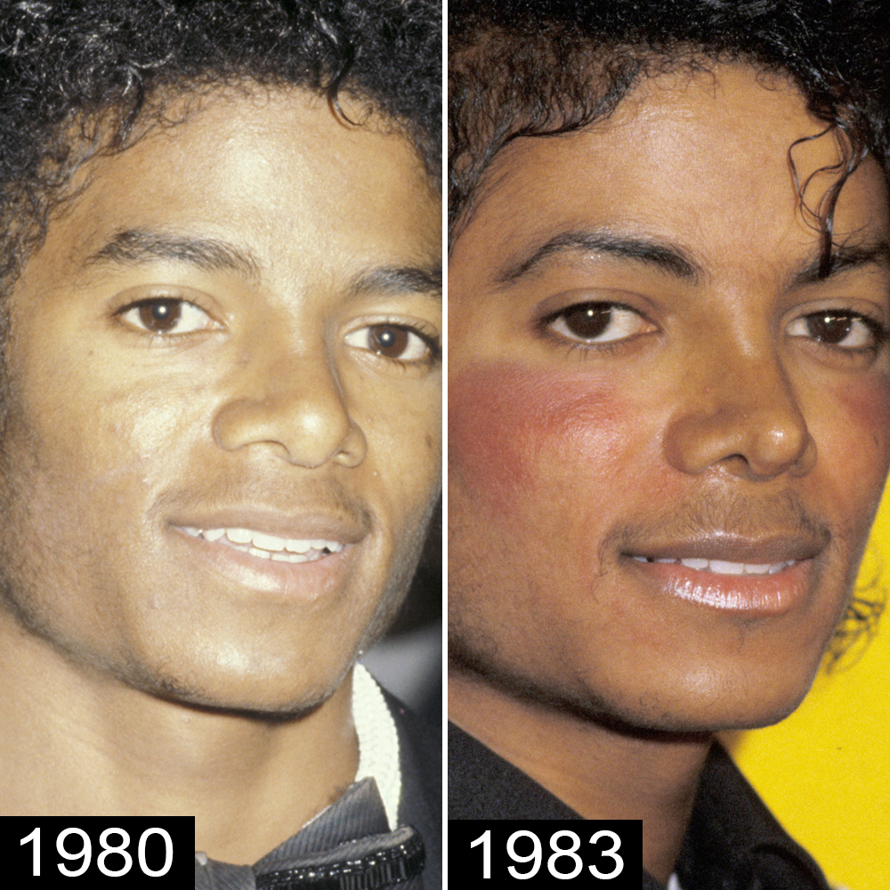 michael jackson prosthetic nose missing