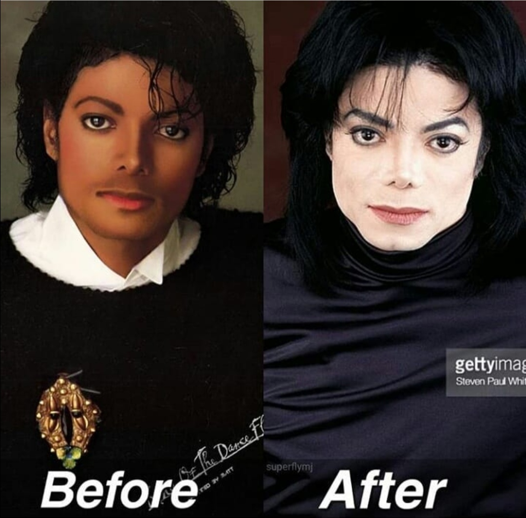 Plastic Surgery Michael Jackson